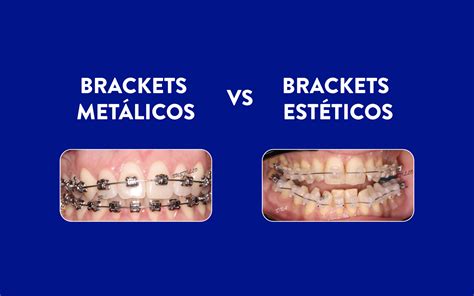 cual es la diferencia entre brackets metalicos y ceramicos|Brackets Metálicos o Estéticos: Cómo el.